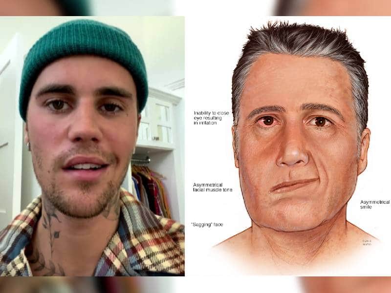 ¿Qué es el Síndrome de Ramsay Hunt? el diagnóstico de Justin Bieber