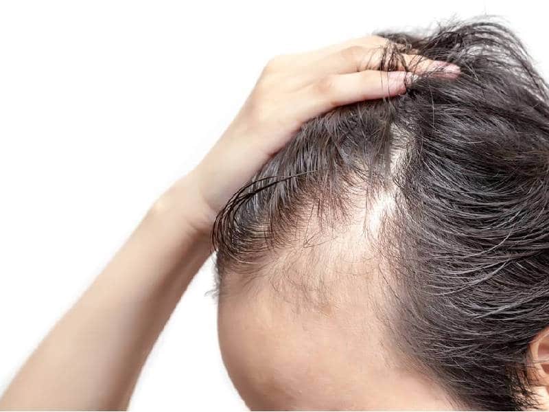 EU aprueba primera píldora para el tratamiento de la alopecia