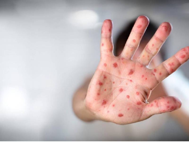 Van 60 casos de viruela símica en 11 estados de México: Salud