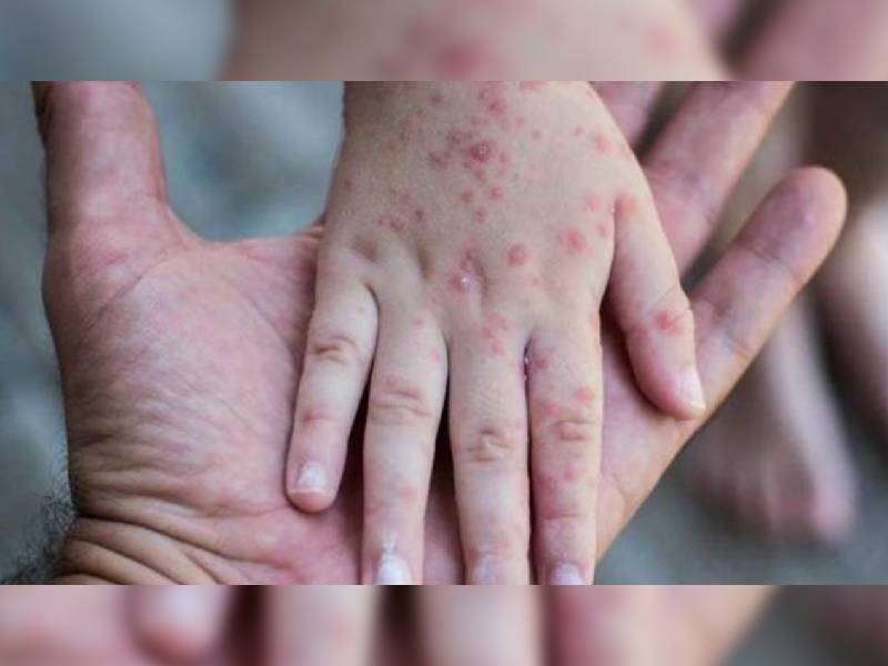 Se confirman 91 contagios de viruela símica en México