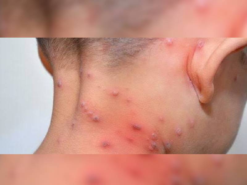 Se duplican casos de varicela en Yucatán