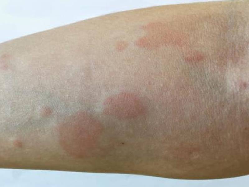 Lupus