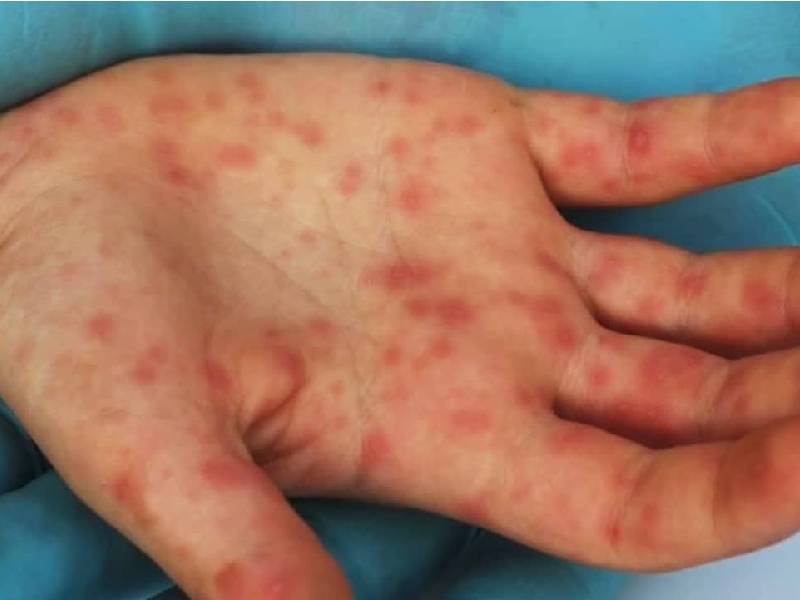 Se confirma segundo caso de viruela símica en la CDMX