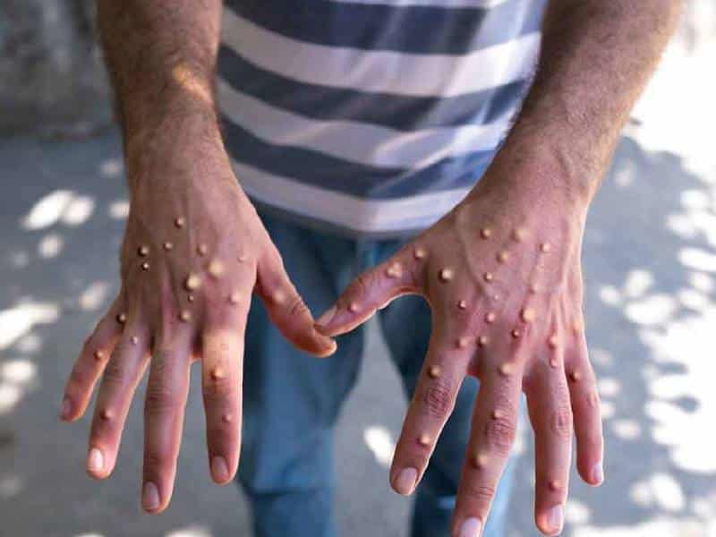 Detectan más contagios de viruela símica; van 17