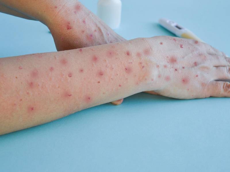 Dolor, miedo y estigmas: Viruela del mono tiene repercusiones psicológicas