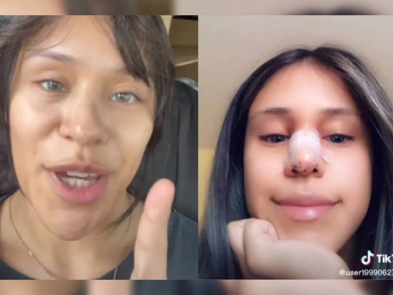¡Mente de tiburón! Perdona infidelidad de su exnovio; le pagó su cirugía de nariz