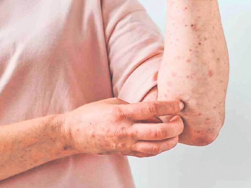 Viruela del mono tiene repercusiones psicológicas