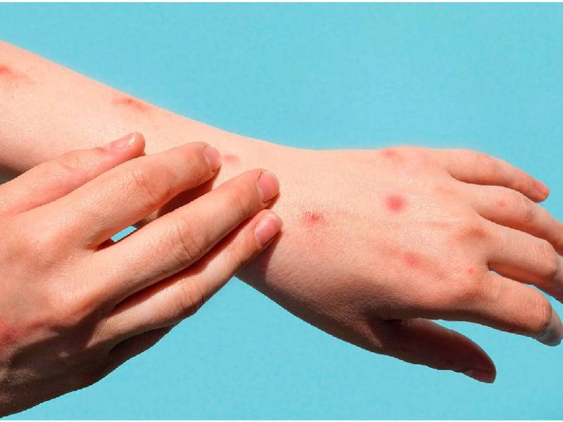 Hay 252 casos de viruela de mono en el país