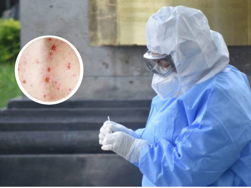 EU declara emergencia de salud pública a la viruela del mono