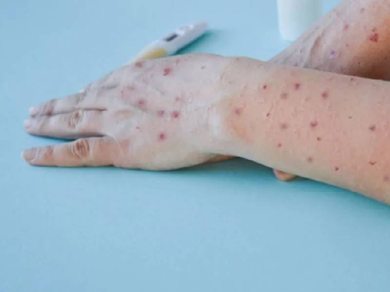 Estudia Salud dos defunciones por posible viruela símica