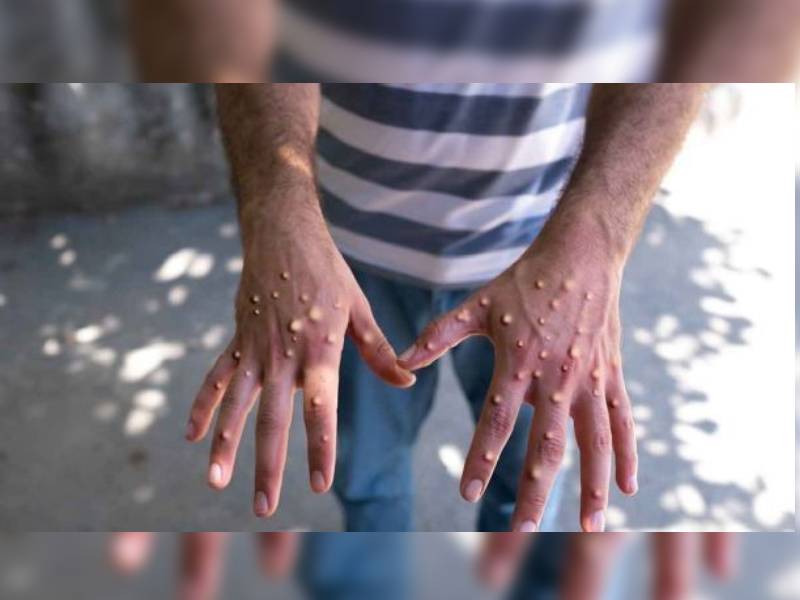Reporta Sesa 10 nuevos casos de viruela símica