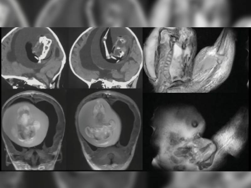 ¡Insólito! Extraen “gemelo parásito” del cerebro de una bebé