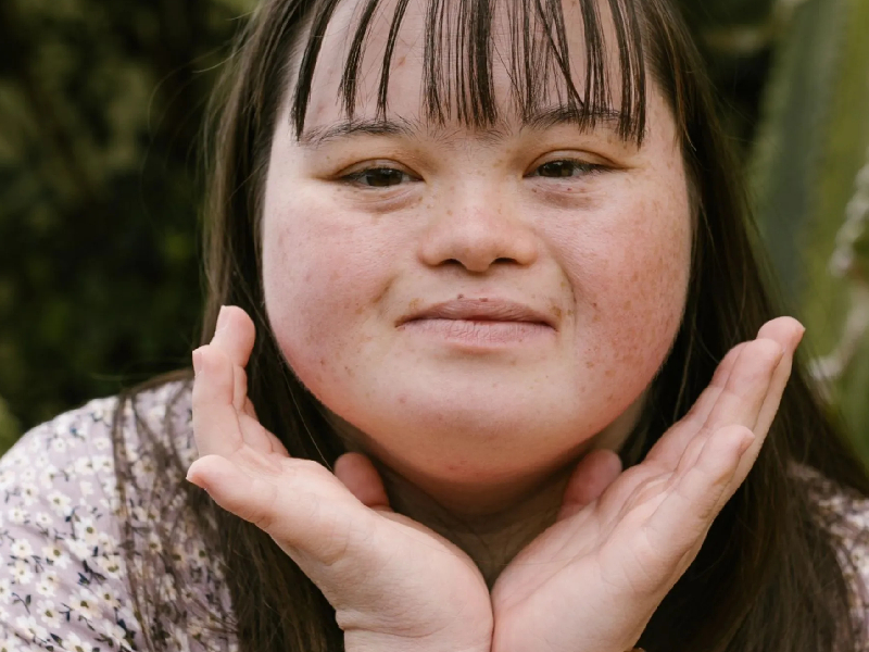 sindrome de down