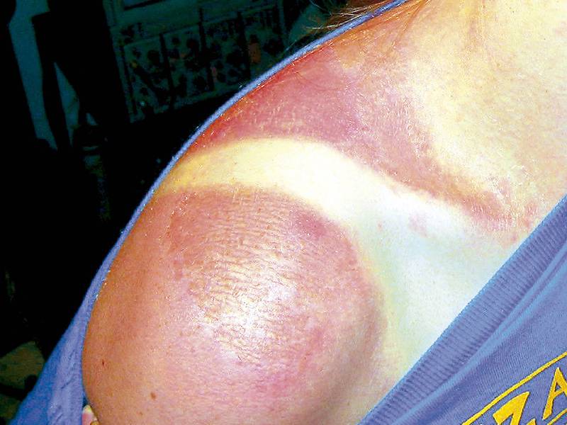 Alertan por enfermedades de la piel causadas por exposición al sol 