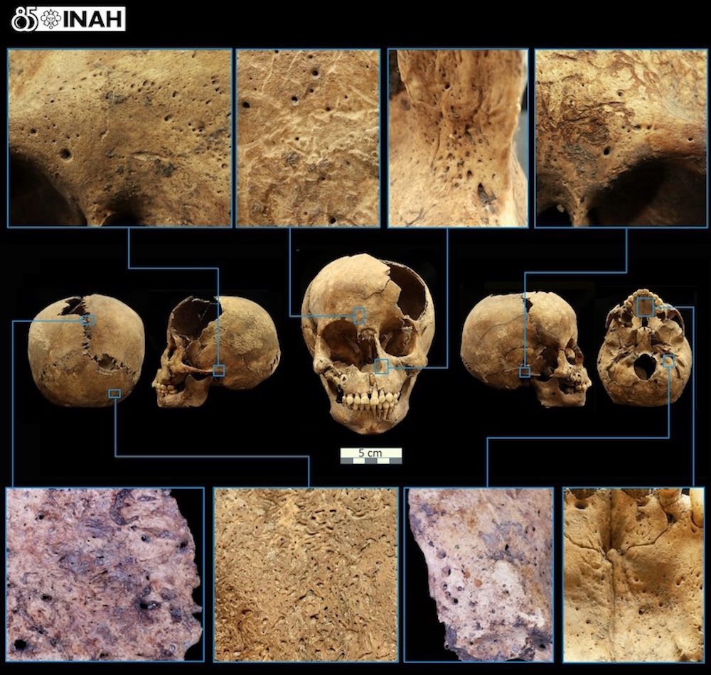 Un estudio en Nature revela que la bacteria de la sífilis tuvo alta diversidad en América antes de la llegada de Cristóbal Colón.
