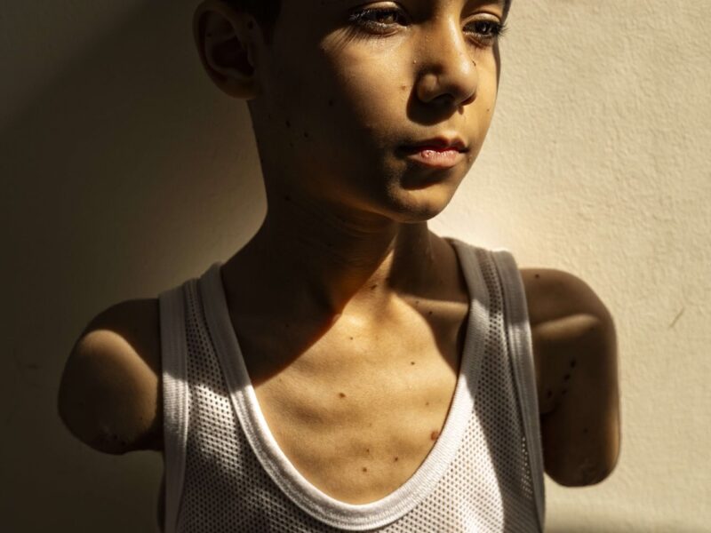 El retrato de un niño palestino amputado por un ataque en Gaza gana el World Press Photo 2025. La imagen conmueve al mundo desde Ámsterdam.