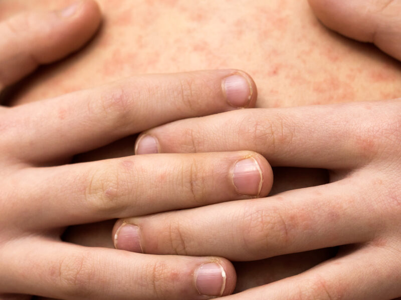 Brote de sarampión en México: Yucatán, entre los estados con menos casos confirmados