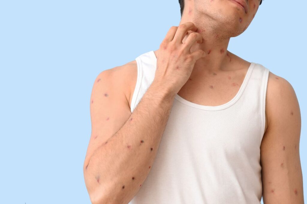 Secretaría de Salud reporta tres casos de viruela símica en Yucatán este 2026