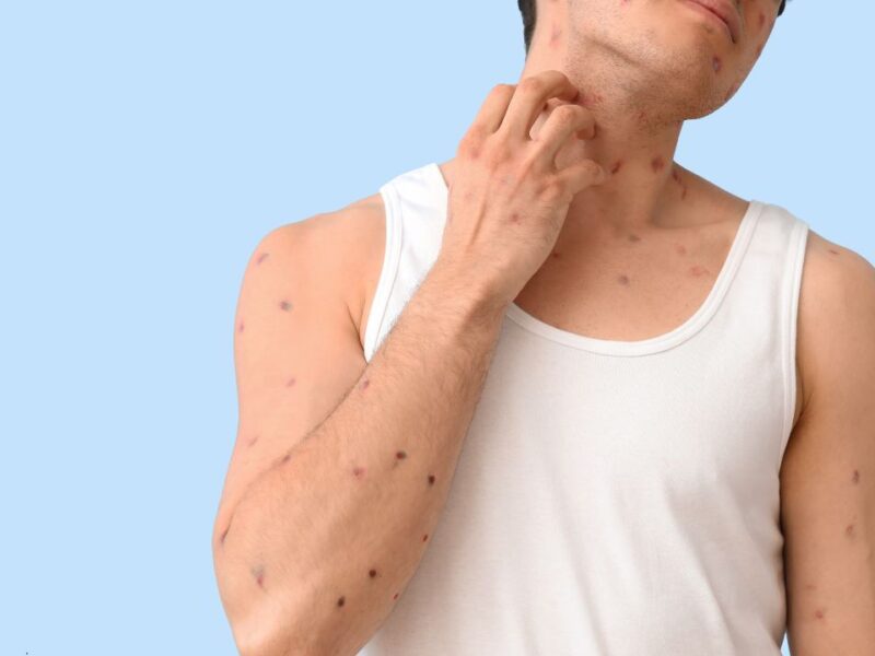 Secretaría de Salud reporta tres casos de viruela símica en Yucatán este 2026