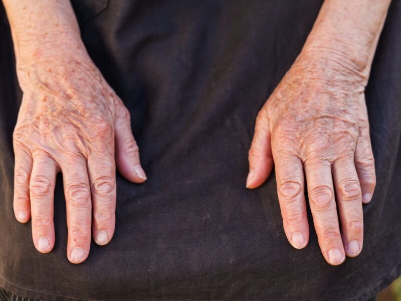 Yucatán registra la mayor incidencia de Artritis Reumatoide en México