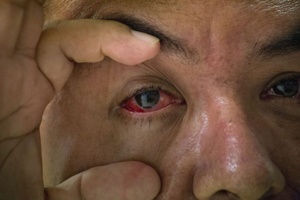 Conjuntivitis suma 295 nuevos casos en una semana en Yucatán
