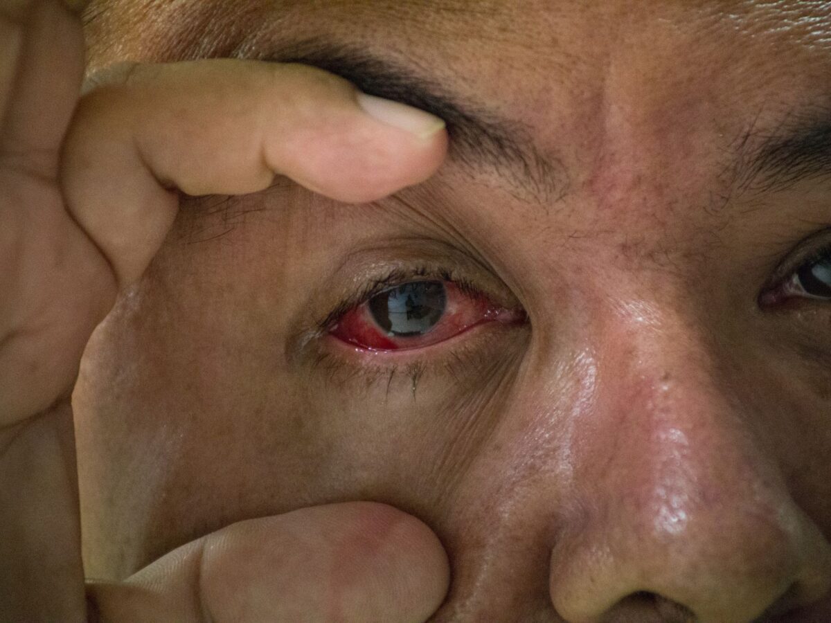 Conjuntivitis suma 295 nuevos casos en una semana en Yucatán